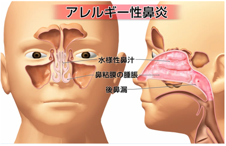 アレルギー性鼻炎