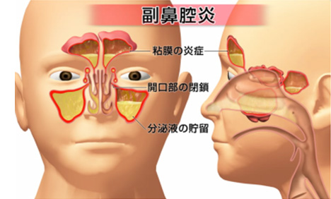 慢性副鼻腔炎 蓄膿症 鼻茸 鼻ポリープ どい耳鼻咽喉科 船橋日大駅前院