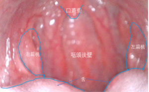 扁桃 腺 炎 コロナ