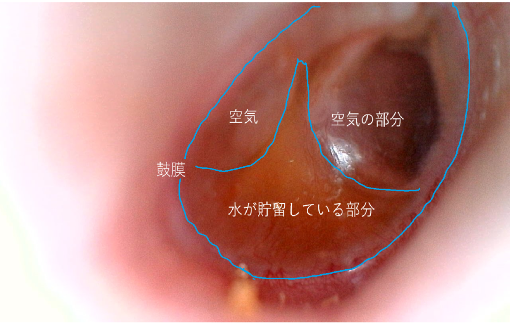 OME はどのように診断されますか?